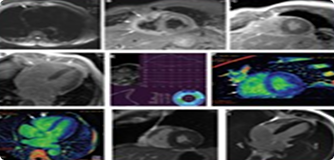 Cardiomyopathy and Myocarditis  “Multi Modality Imaging
