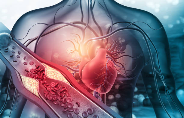 Workshop 4  : CHD